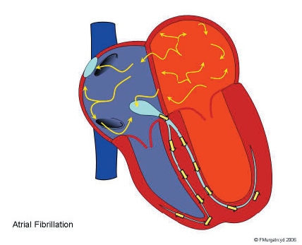What is an Arrhythmia?